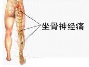 最粗长的针刀治疗女性坐骨神经痛,梨状肌导致的坐骨神经痛怎么治疗