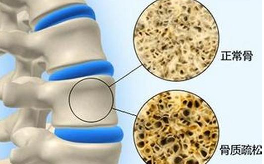 骨质疏松压缩性骨折治疗指南2022,骨质疏松脊柱骨折诊疗指南