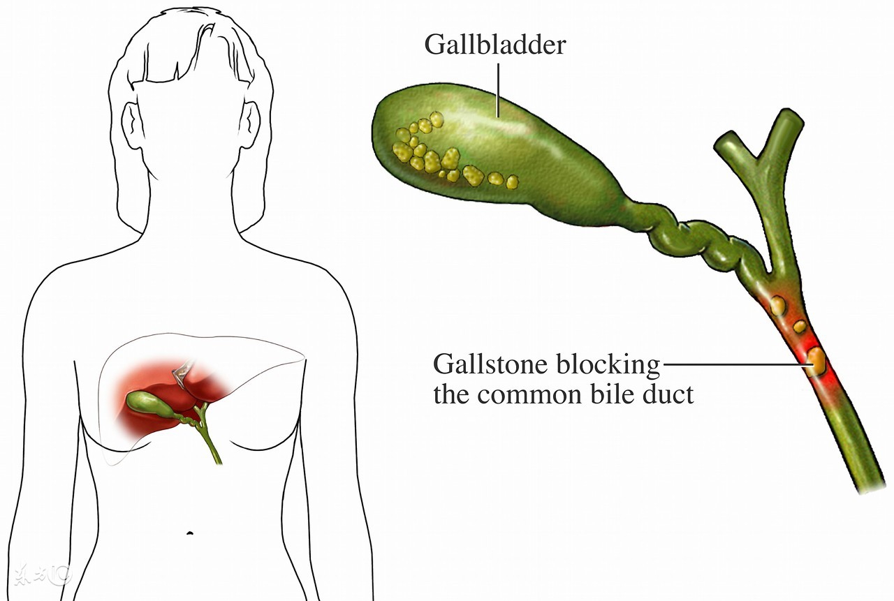 胆囊结石胆囊炎为什么不能吃鸡蛋,胆囊炎胆囊壁增厚0.4能吃鸡蛋吗