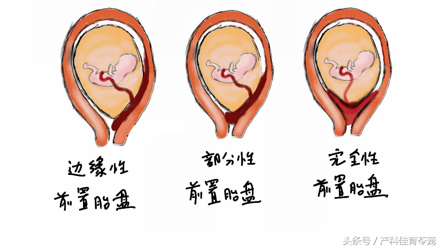 胎盘低就是前置胎盘吗,胎盘位置低在前壁