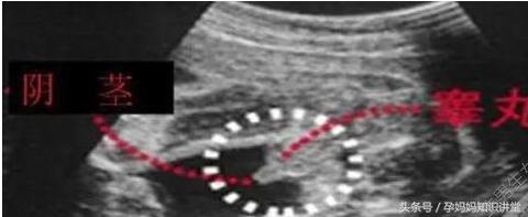 胎儿生男生女,b超怎么看出胎儿姓名