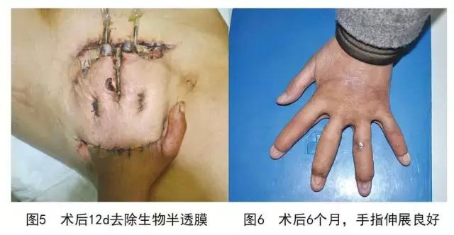 vsd负压引流加皮瓣移植,vsd植皮和皮瓣手术哪个损伤大