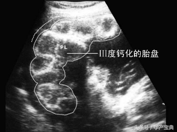 孕晚期吃西柚会使胎盘老化吗,孕晚期胎盘老化导致胎儿偏小