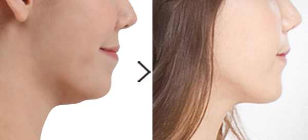 脸部训练器能减掉双下巴吗,怎么减掉脸上的肉和双下巴