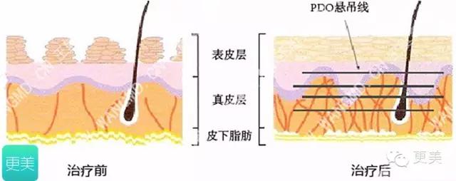 埋线美容线和不吸收线有什么区别,医院埋线和美容院埋线有什么差别