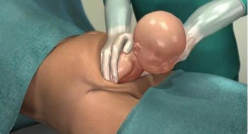 给孩子看的剖腹产手术全部流程,剖腹产手术最详细的介绍