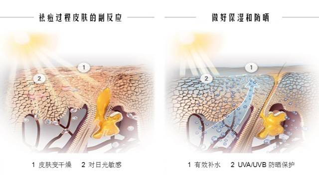 痘疮病怎么治疗,痘疮的中医辨证治疗