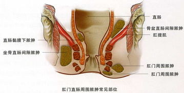 宝宝屁股长脓包需要开刀吗,宝宝屁股起脓包