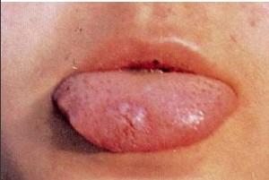 为什么刷牙会得口腔炎,婴幼儿为什么会得口腔炎