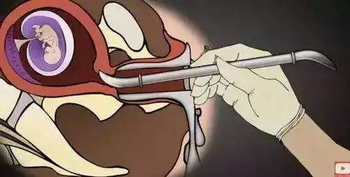 男的会接受女朋友打胎吗,你会建议你的女朋友打胎吗