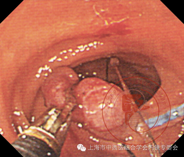 内镜套扎是什么,内镜套扎器械