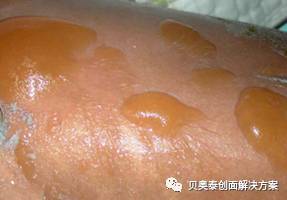 烧伤深度与临床表现图,氢氟酸烧伤的临床表现
