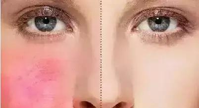 激素脸为什么越来越痒,怀孕激素脸越来越严重