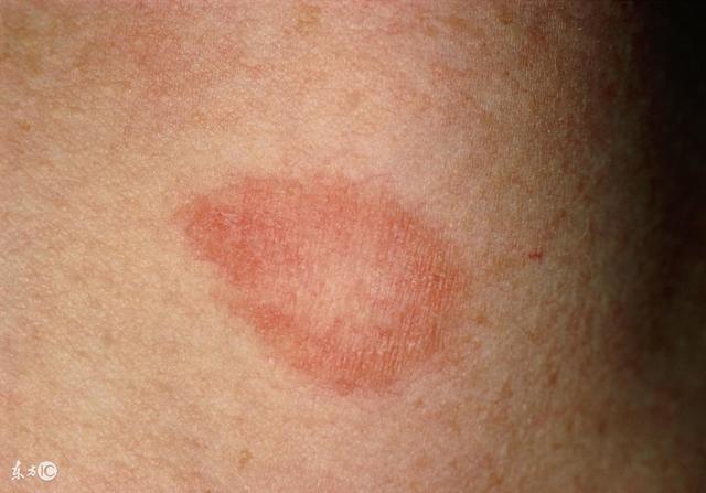 癣的种类分别怎么治疗,癣的诊断