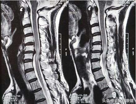 颈椎病这些知识您了解吗,颈椎病常见康复治疗方法