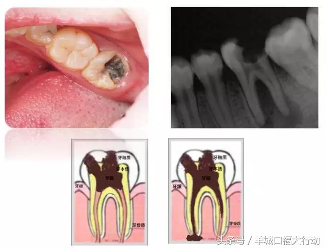 龋齿蛀牙有虫吗,科普蛀牙的形成