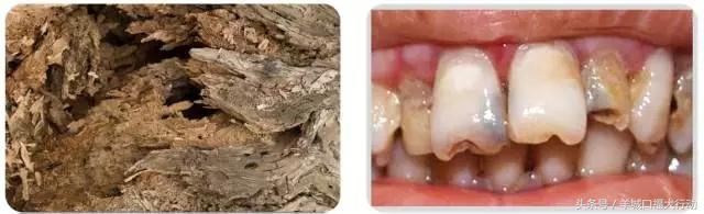 龋齿蛀牙有虫吗,科普蛀牙的形成