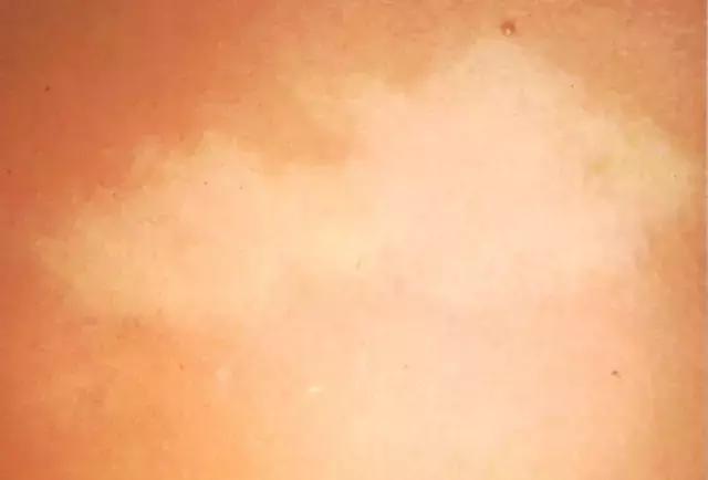 省̥妇̥幼̥专家提醒，宝宝出生有这些印记，一定要去！医！院！