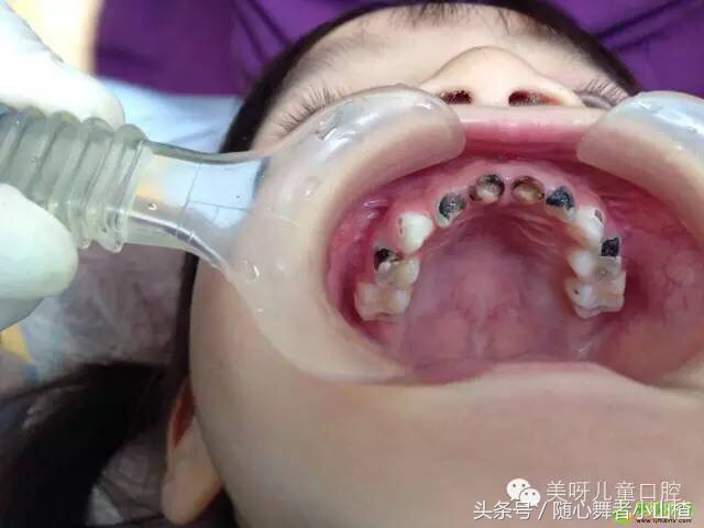 宝宝门牙牙齿一部分比较白,有没有小孩长着锯齿状牙齿