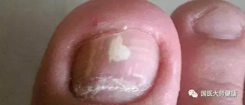 指甲上的月牙预示着什么,指甲上的月牙真的和健康有关系吗