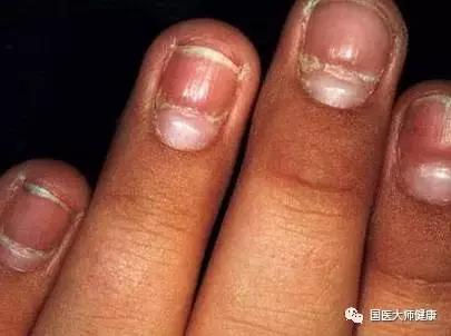 指甲上的月牙预示着什么,指甲上的月牙真的和健康有关系吗