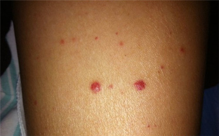 身上有小红痣不痛不痒是怎么回事,人到中年身上长小红痣是什么原因