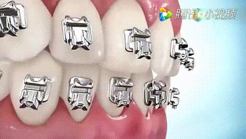 全瓷牙套怎么才算安装好,牙齿矫正有几种牙套图片