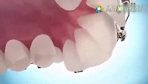 全瓷牙套怎么才算安装好,牙齿矫正有几种牙套图片