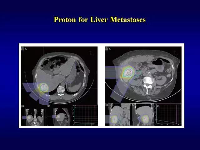 美国洛马林达质子治疗中心GaryYang：消化道肿瘤的质子放疗治疗