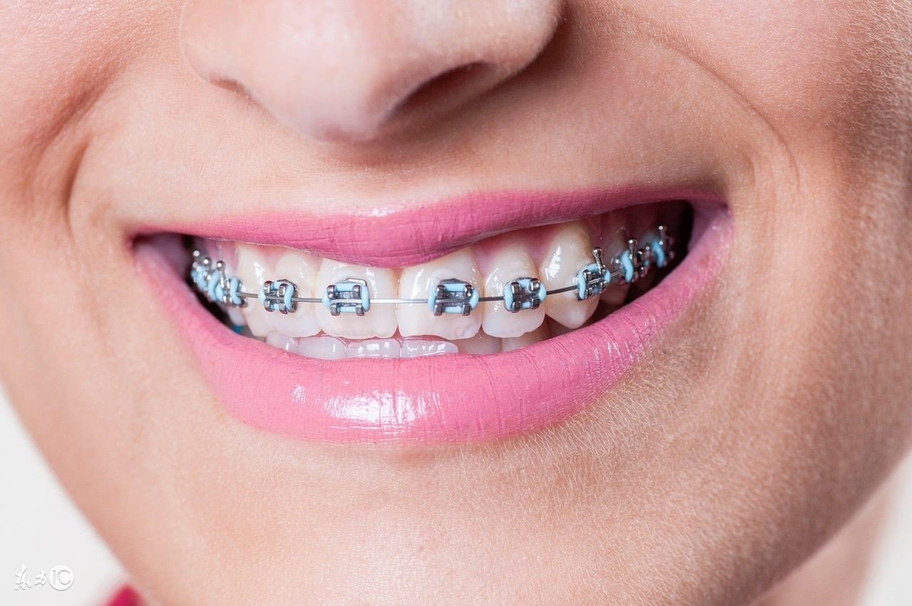 再也不做钢牙妹｜3D打印隐形牙套—上海正雅齿科获5000万B轮投资