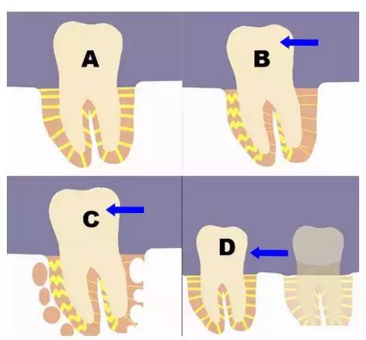 牙整形需要什么过程,整形整牙全过程