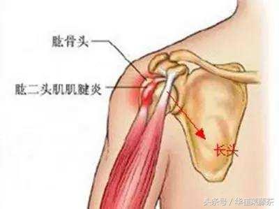 肩周炎右肩膀疼痛,冬天肩周炎肩膀痛怎么办