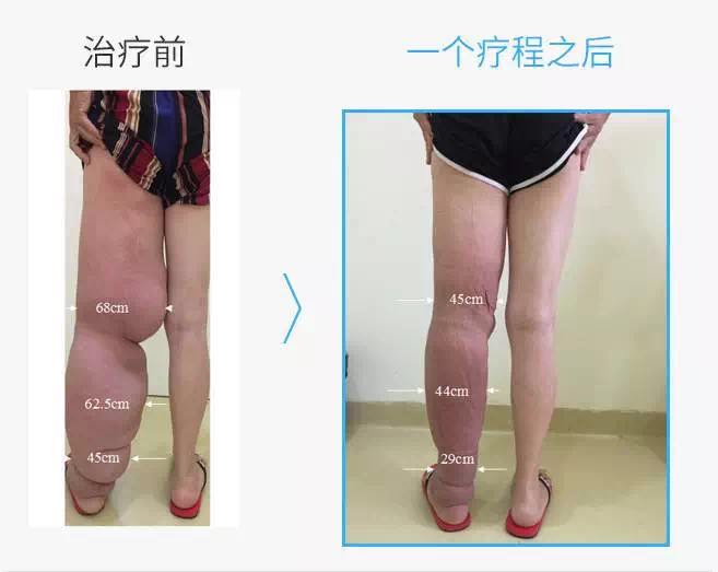 淋巴水肿皮肤发硬怎么治疗,淋巴水肿患者的早期症状
