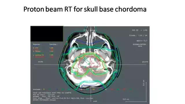 「演讲PPT」法国居里研究所PierreBey:颅底肿瘤的质子放疗