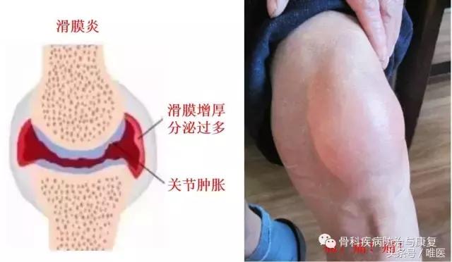 如何消除关节炎的肿胀积液,怎么确诊滑膜炎和膝关节炎