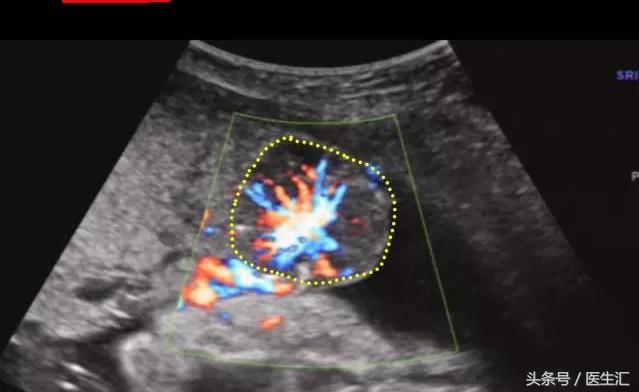 胎盘早剥诊断ppt,胎盘早剥的诊断与护理试题