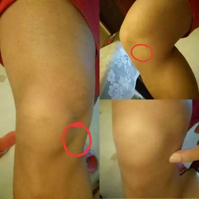 网球肘的最佳打法,三招搞定网球肘