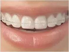 牙缝大的女人漏财吗,牙缝漏财吗