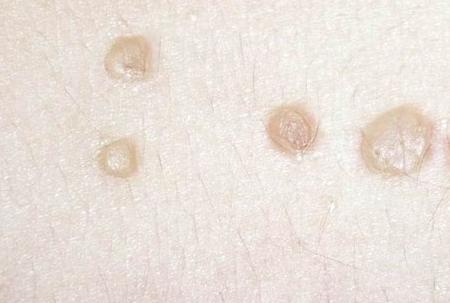 怎么区分扁平疣和皮肤角化症,如何区分脸上的扁平疣和痘痘和斑