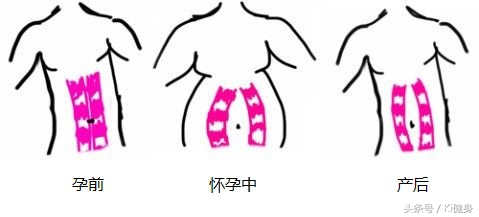 腹直肌及腹直肌分离,腹直肌脐部分离