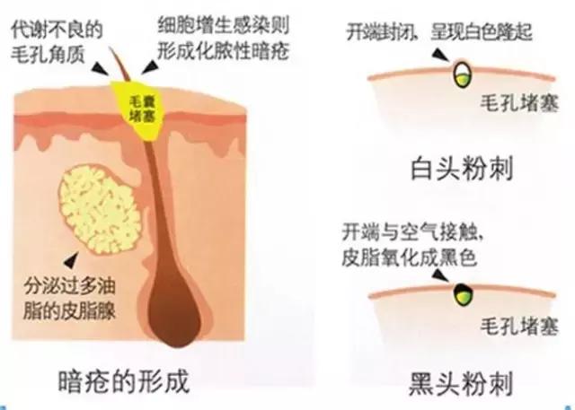 痘痘闭口摸起来还有点疼痛,痘痘闭口反反复复怎么办