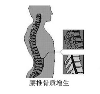 骨刺其实不是病别再被忽悠了,骨刺有多可怕视频