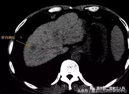 微波消融术后肿块多久才能消,甲状腺肿块微波消融