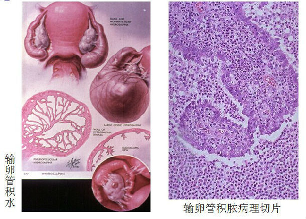 试管促排第九天时发现输卵管积水,试管婴儿输卵管造影