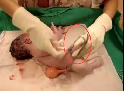 新生儿脐带被医生剪太长了怎么办,刚出生的婴儿被护士剪肚脐