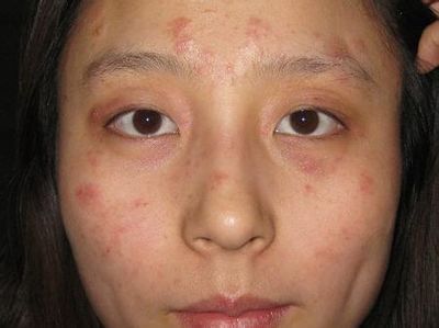 患了湿疹怎么办教你一招简单高效,湿疹怎么办最有效小方法