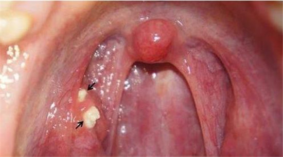 怎么可以彻底治愈扁桃体结石,慢性扁桃体结石怎么治疗最有效