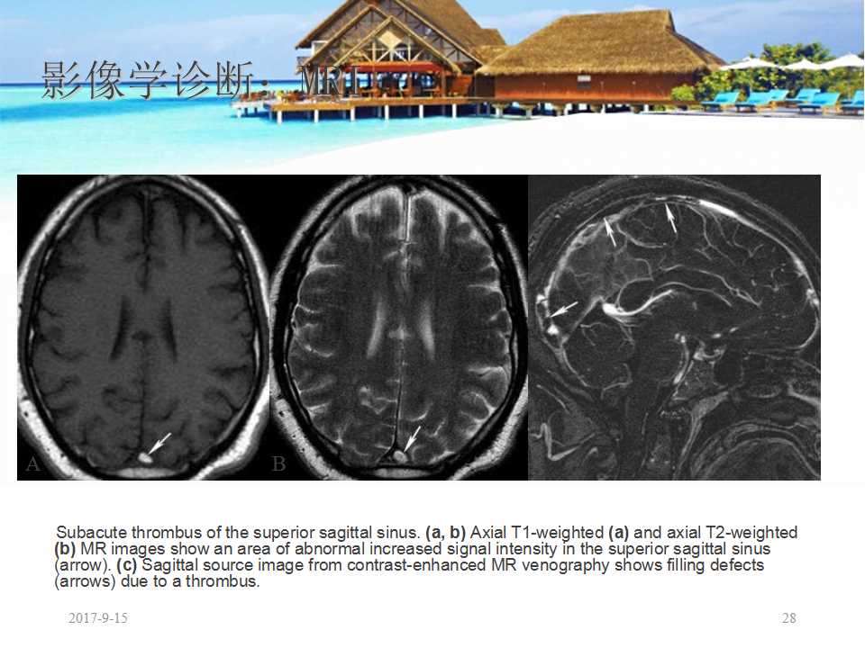 颅内静脉窦血栓形成怎么治疗,颅内静脉窦血栓形成最佳治疗方法
