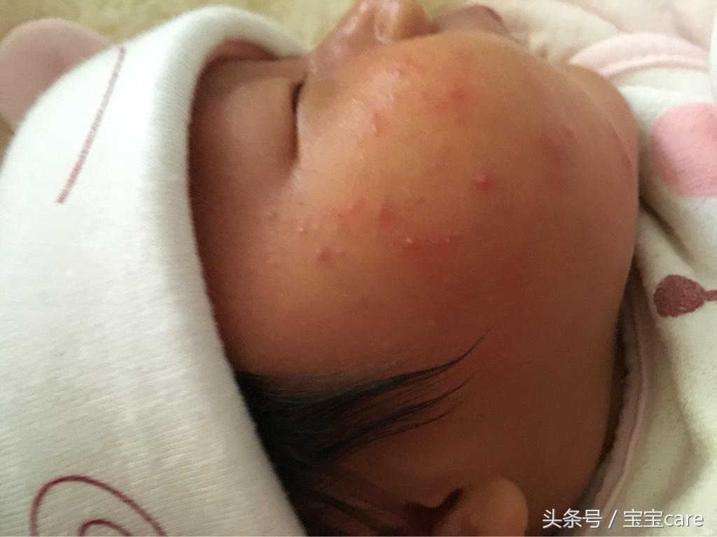 宝宝身上长密密麻麻小疙瘩怎么办,宝宝身上长小疙瘩不红