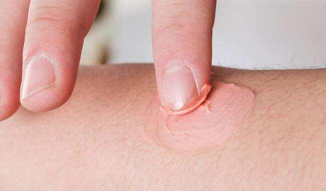 患了湿疹怎么办教你一招简单高效,湿疹怎么办最有效小方法